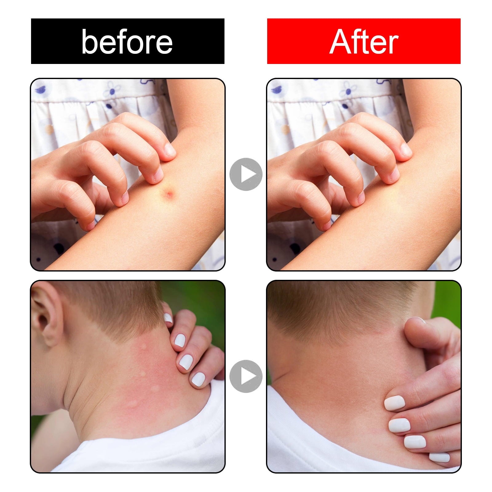 2 Pack Kid Safe Anti-Itch and Anti-Sting Spray for Mosquito Bite Relief, Bug Bite Itch Relief, Bee Stings, Hives and More